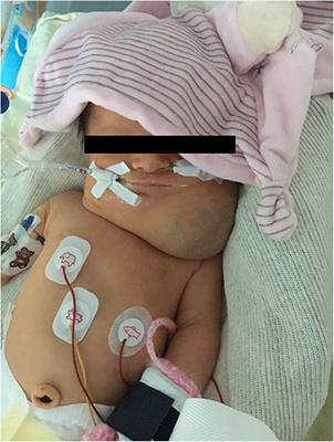 Early Adjuvant Medication With the mTOR Inhibitor Sirolimus in a Preterm Neonate With Compressive Cystic Lymphatic Malformation